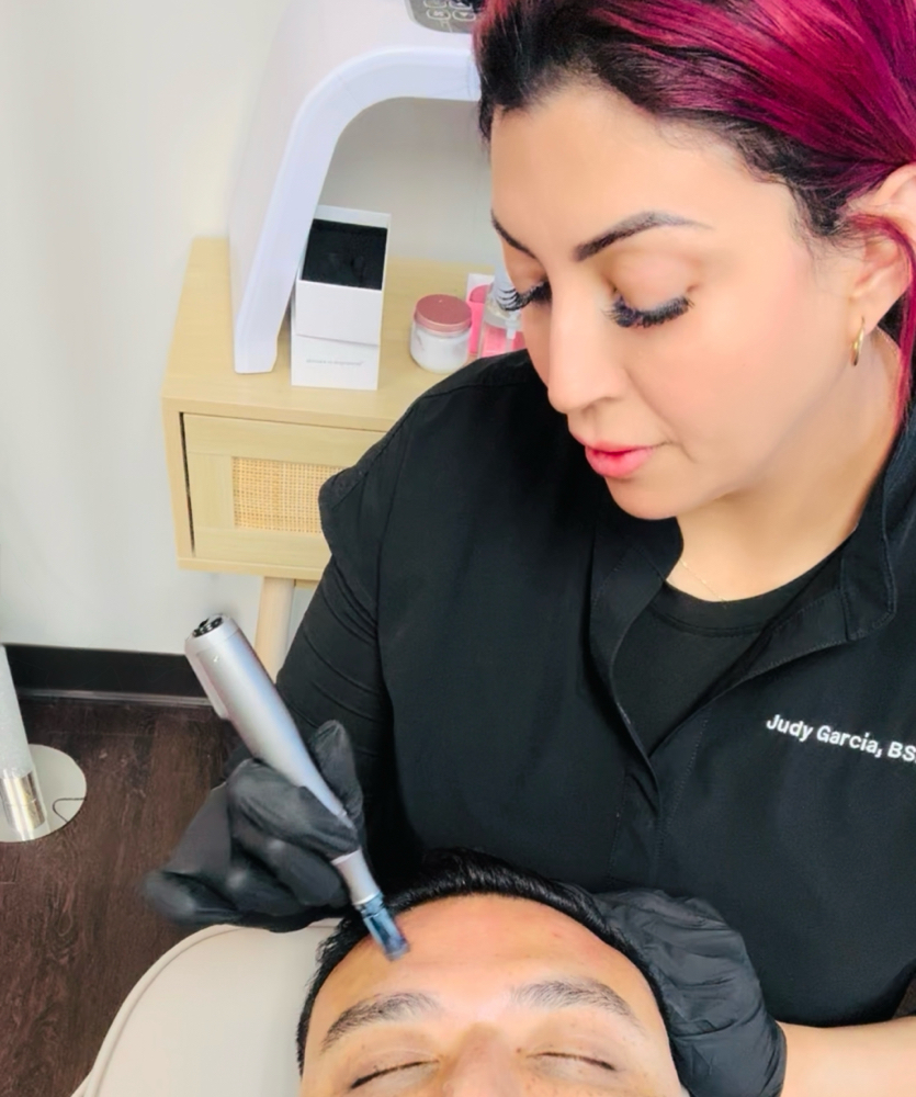 Microneedling Session