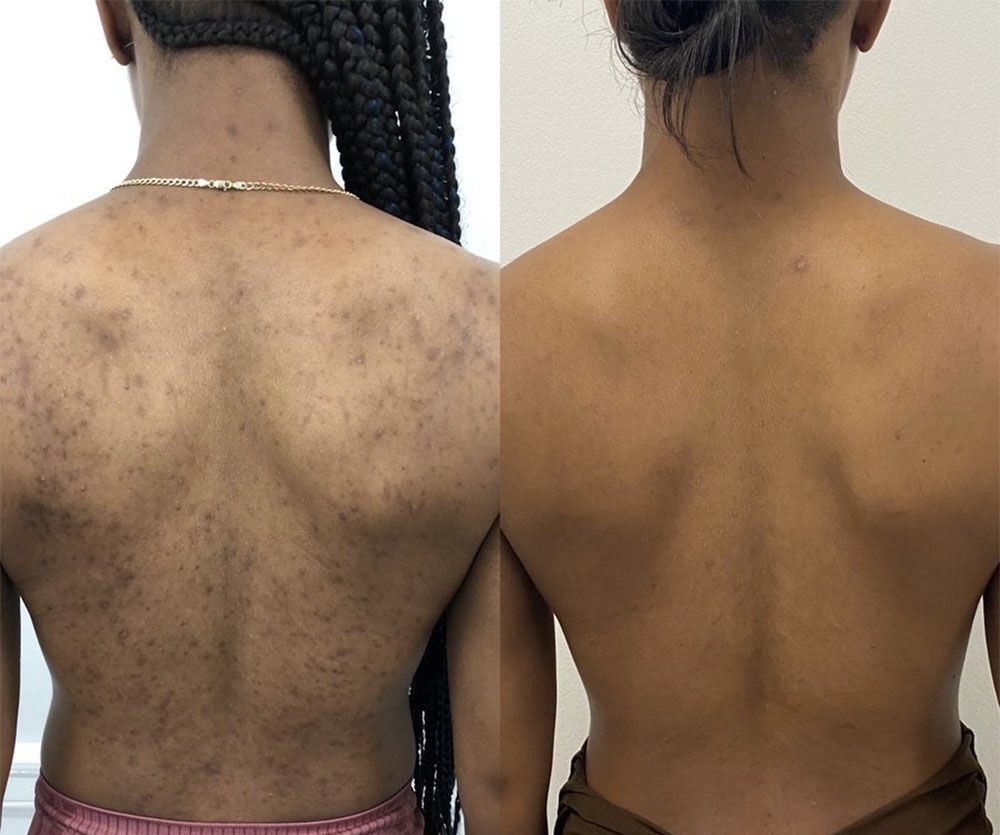 Back Acne Facial