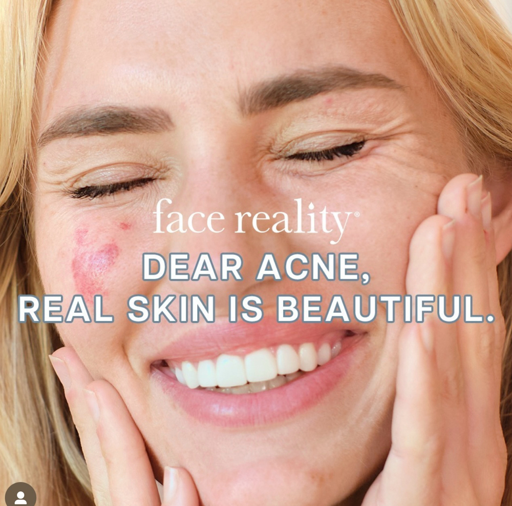Acne bootcamp 1st Visit + consult