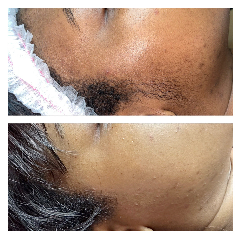 Dermaplaning Facial