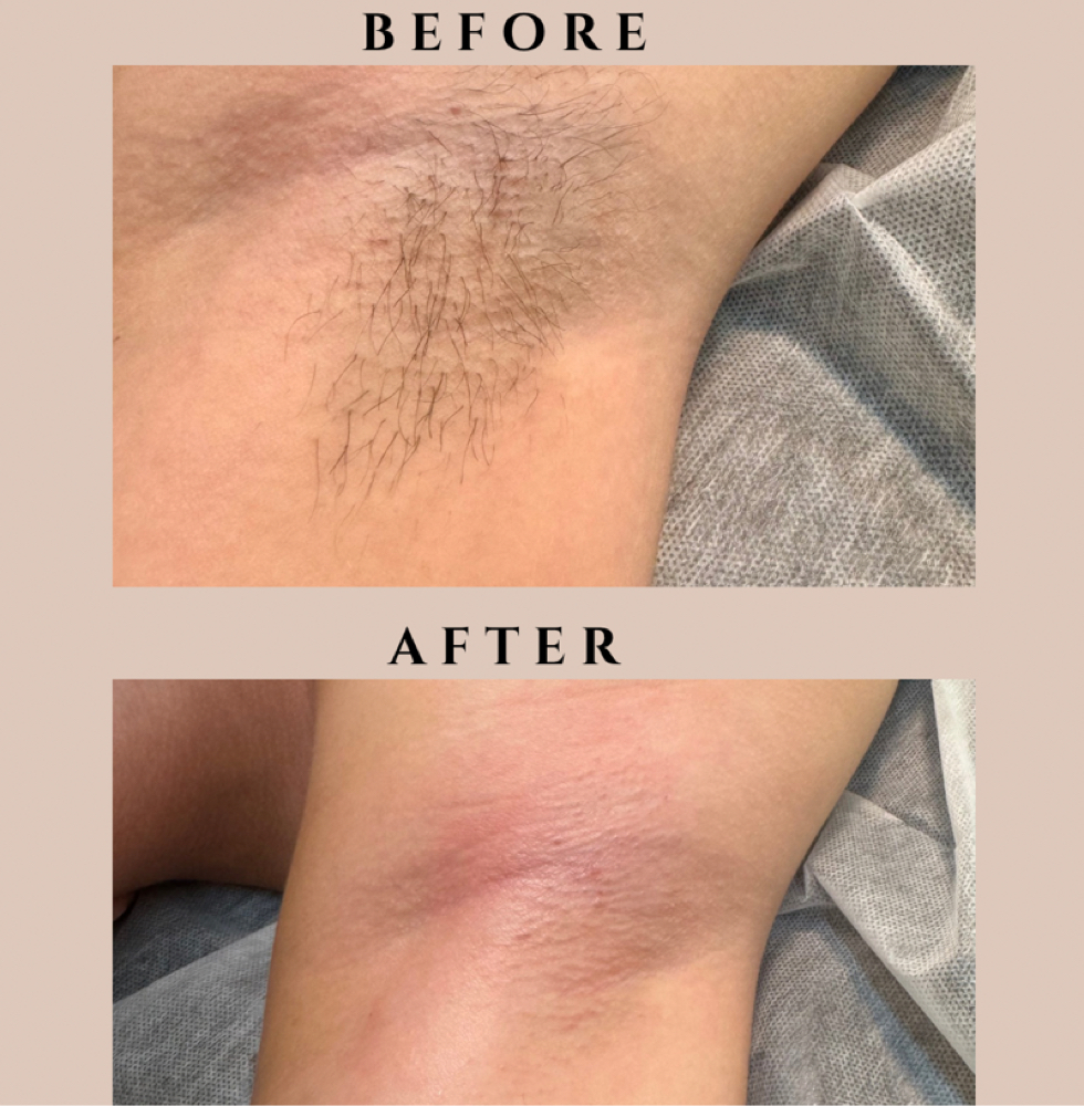 Underarms at GlowHaus Aesthetic in Medford, OR
