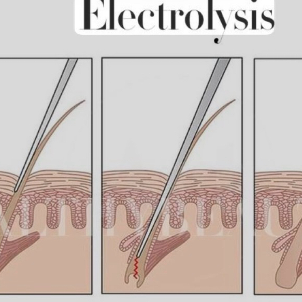 Electrolysis 60 Minutes at ForeverBeauty LLC in Leesburg, VA