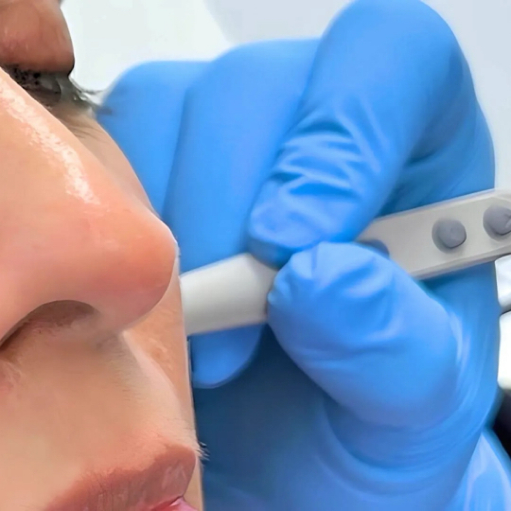 Blemish Removal (Bovie Derm) at Arcana Med Spa in Castle Rock, CO