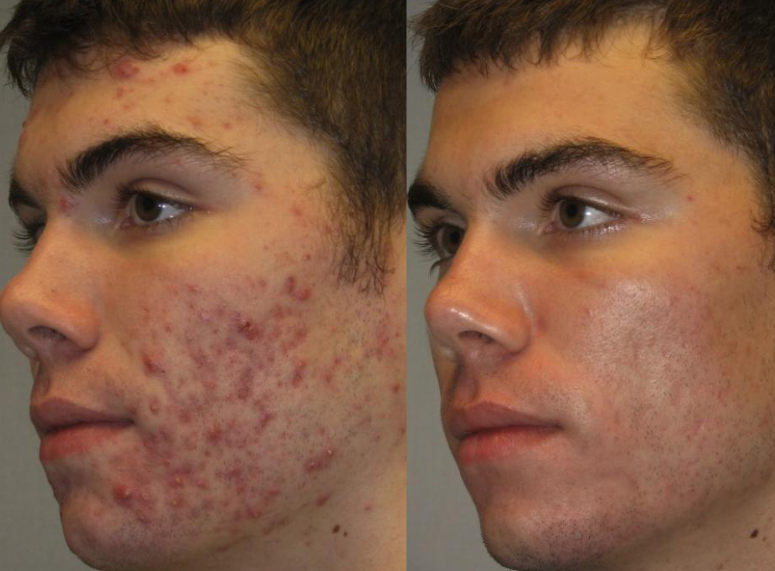 Acne Rescue Treatment & Consult