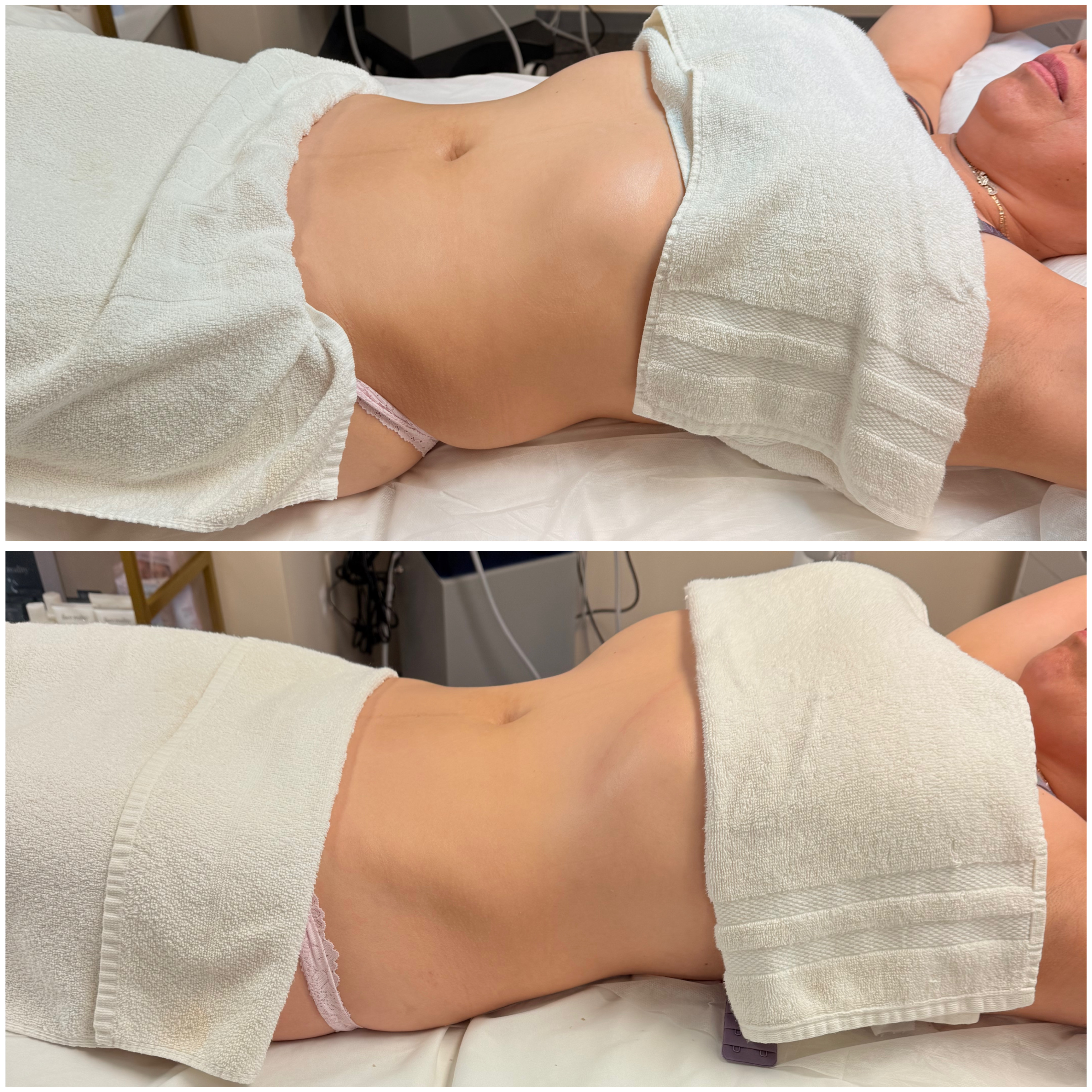 BioShape Body Redux  Treatment
