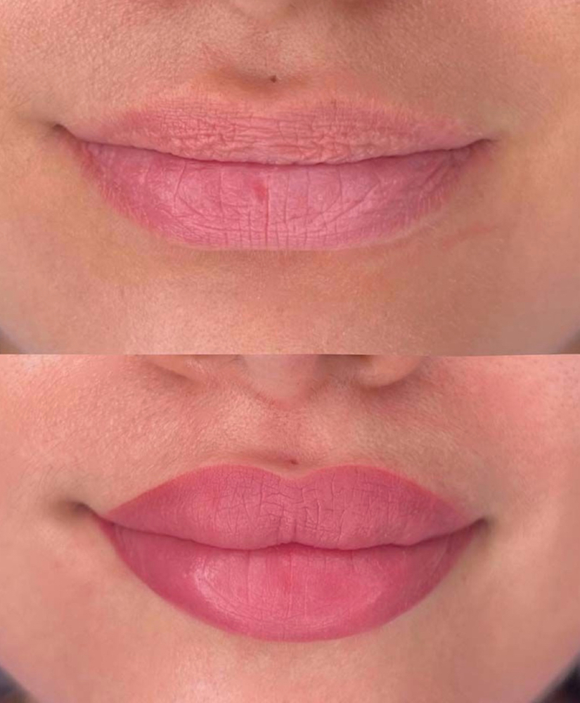 Lip Enhancement