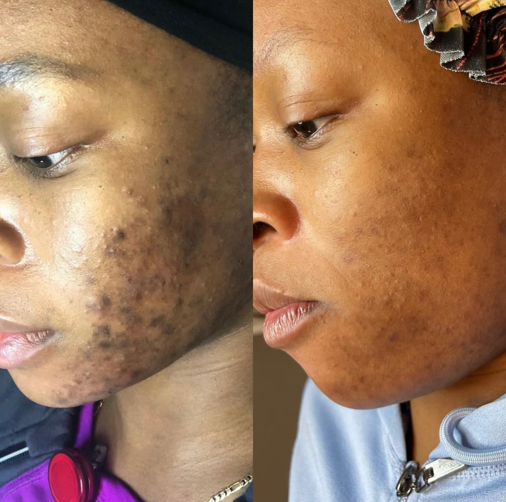 Microneedling