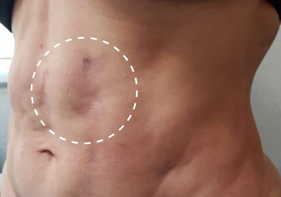 Fibrosis Treatment