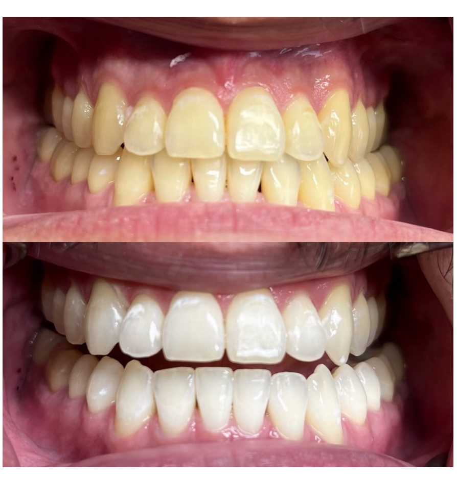 Teeth Whitening Treatment