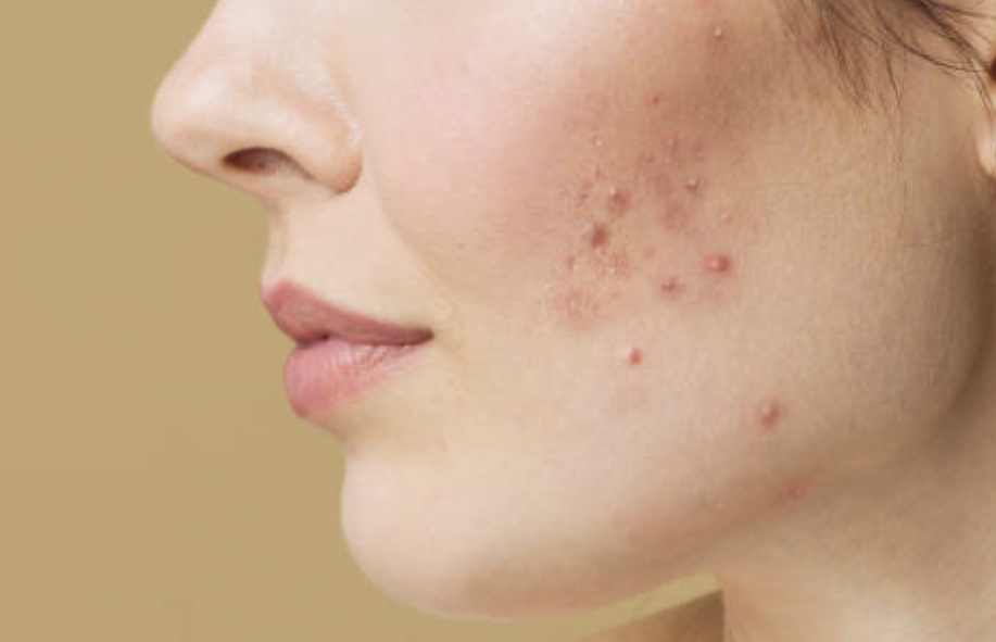 Acne Corrective