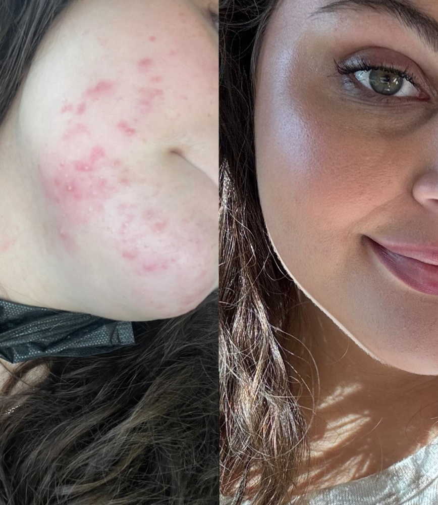Bye-Bye Acne Facial
