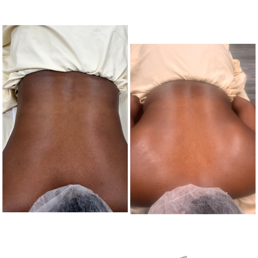 Back facial at Dolls skin in Waukegan, IL