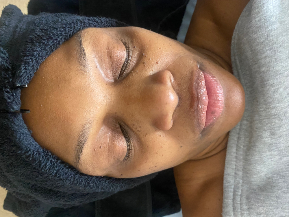 NanoneedlingCollagen Induction