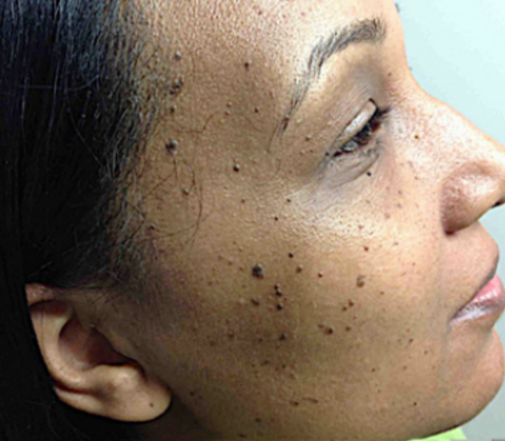 Mole Removal