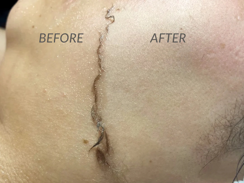 Dermaplane Facial