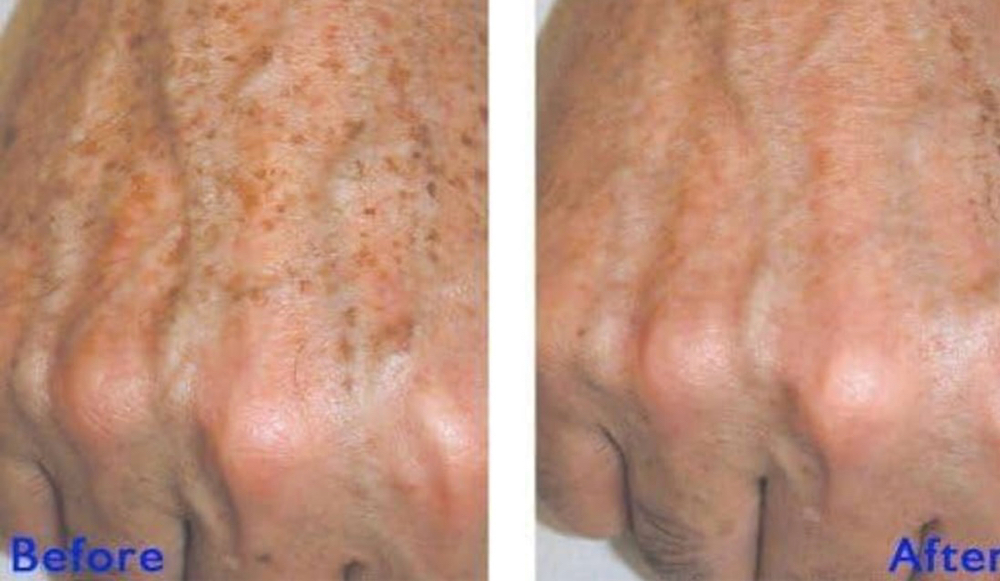 Age Reverse Hand Peel at ReNew in Fort Lauderdale, FL