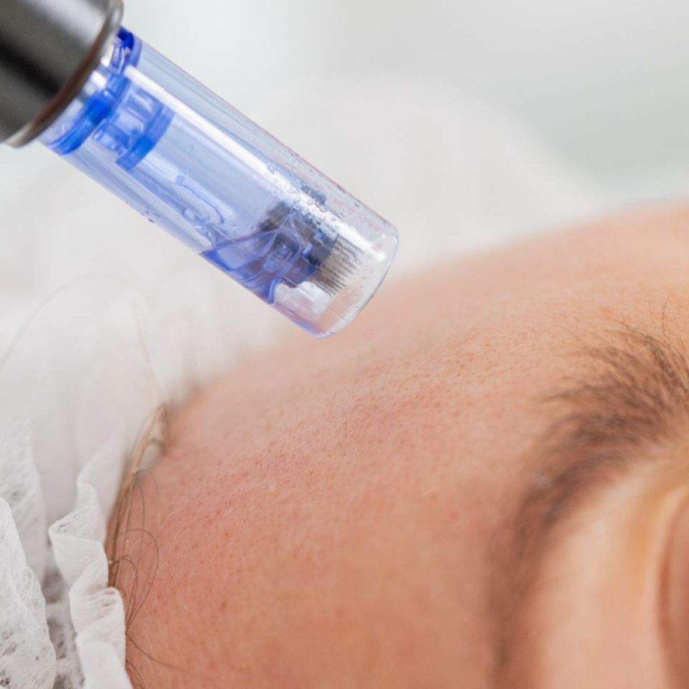 Microneedling at Native Beauty in Garden City, MI