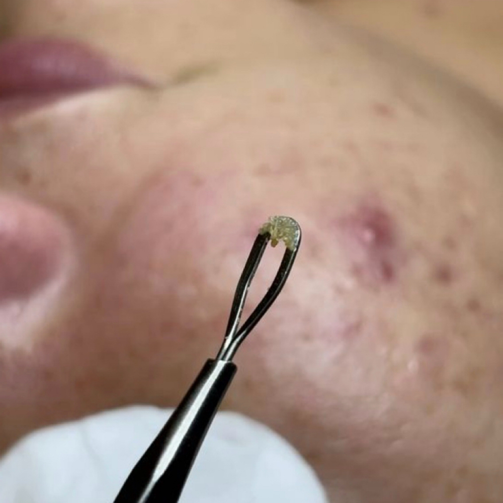 Extractions at Aesthetics by Makinlee in Pahrump, NV