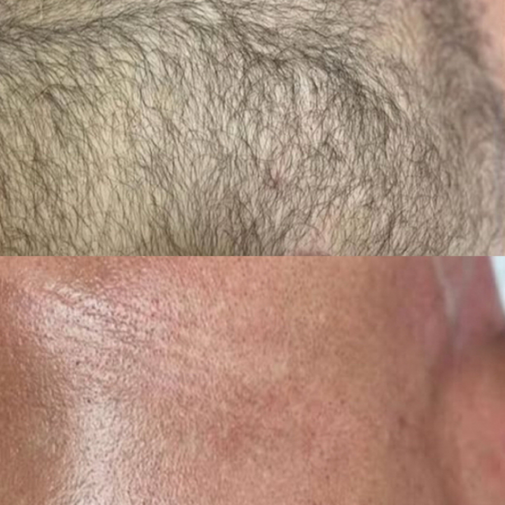 Full Chest Wax at J Esthetics in Homewood, IL