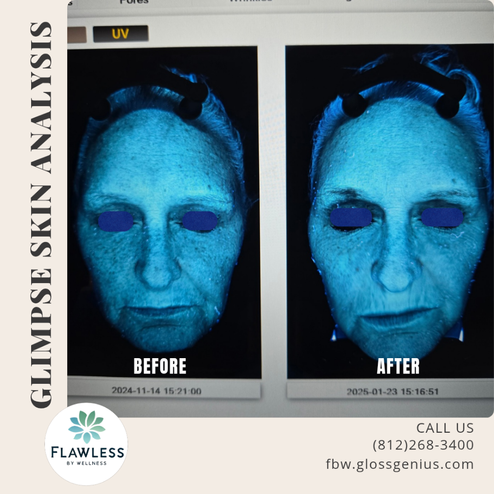 Glimpse Skin Analysis