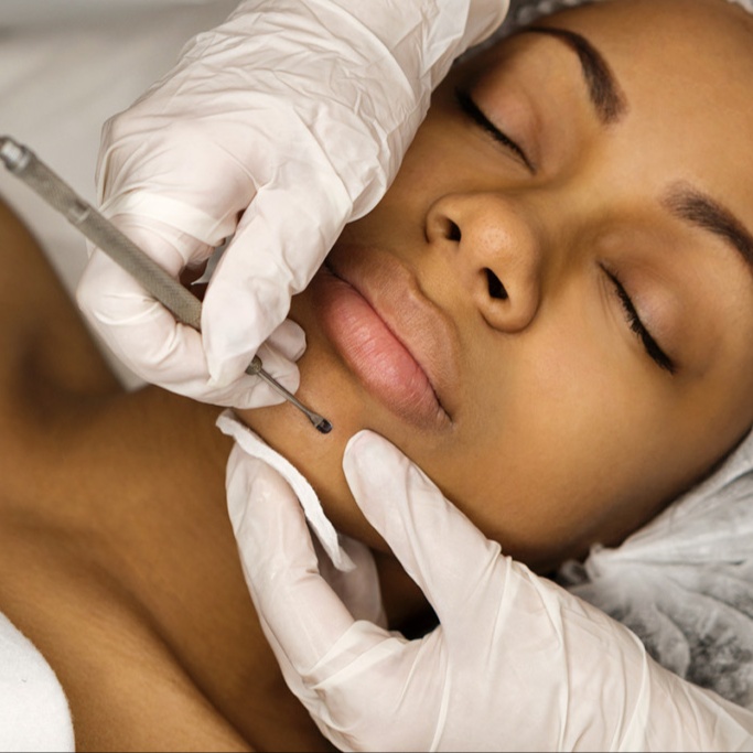 Extractions Only at Radiant Glow Skin Spa in Beaumont, TX