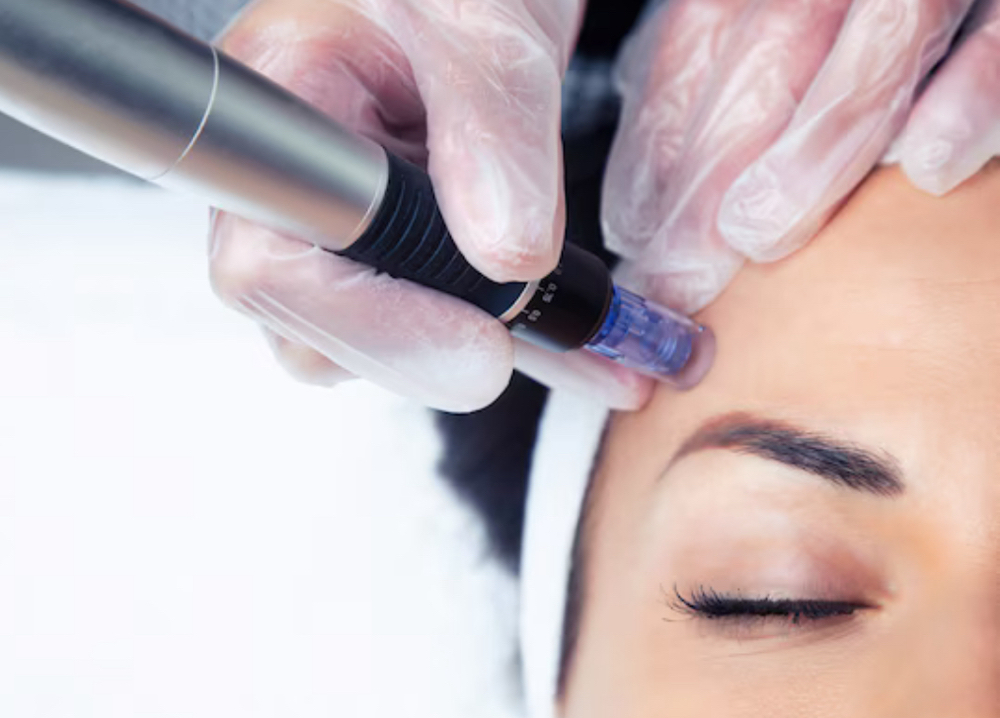 Microneedle Consultation *required