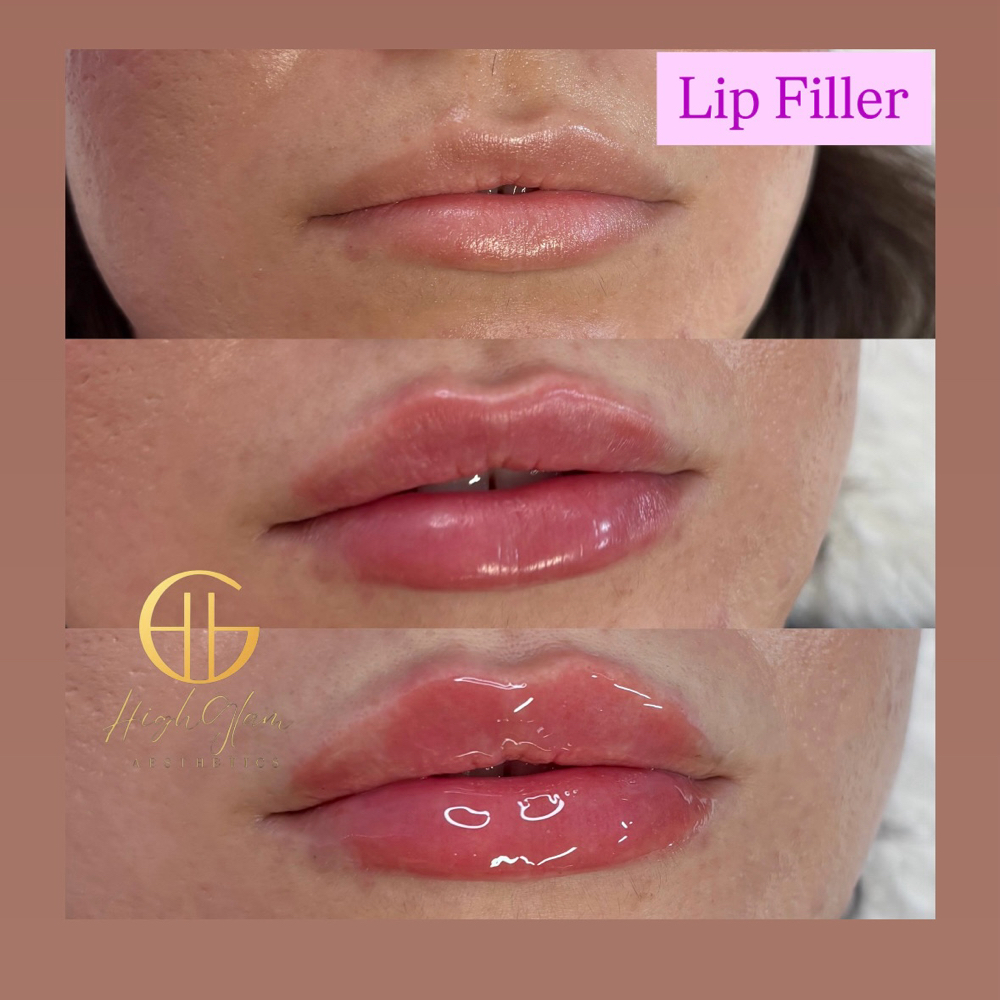 Lip Filler-Classic/Russian/ Bratz
