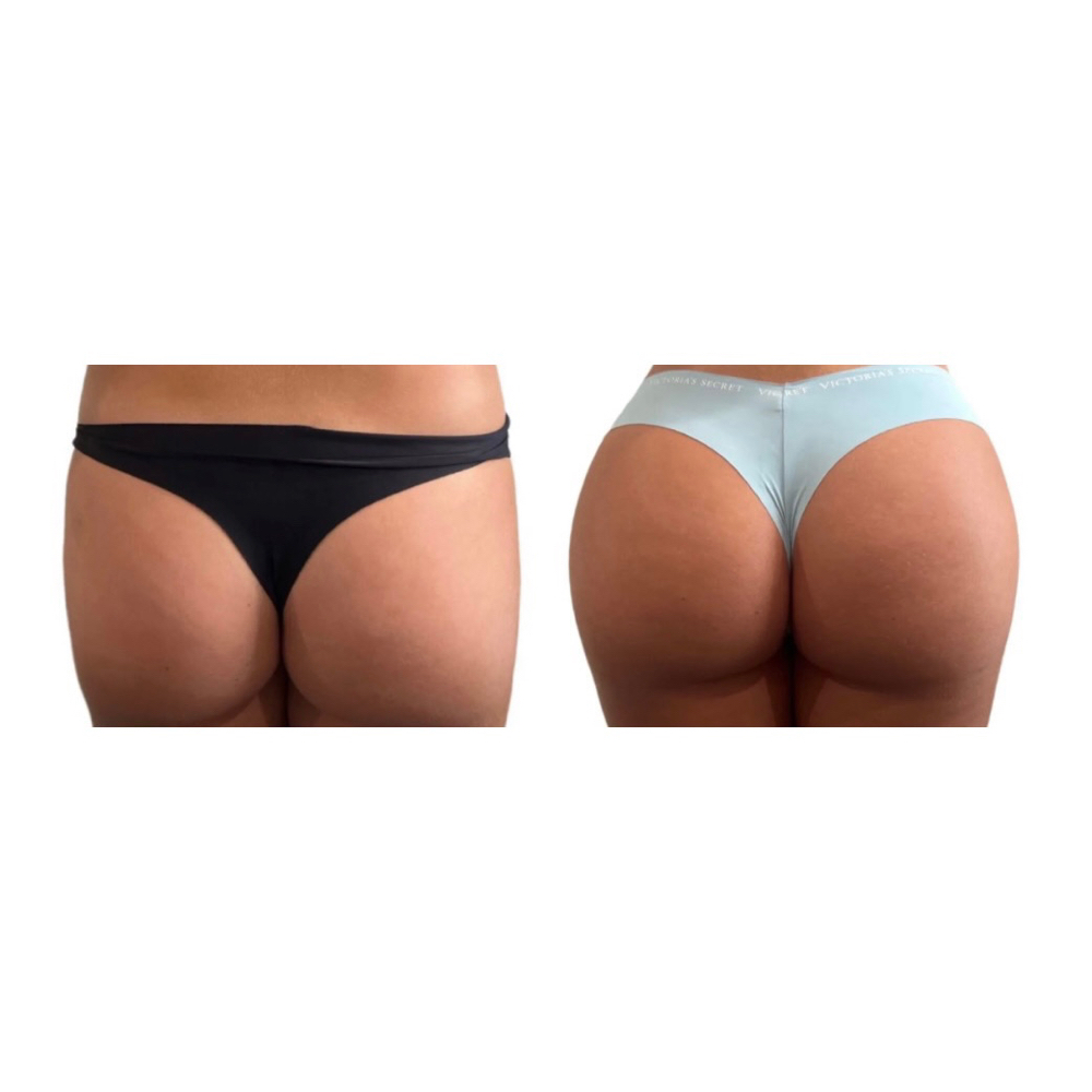 Non Invasive Butt Lift