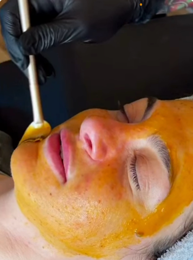 Acne Facial