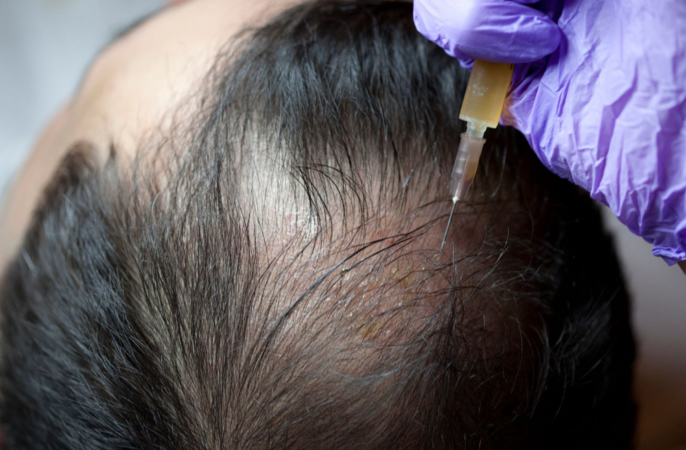 PRP Therapy For Hair Loss