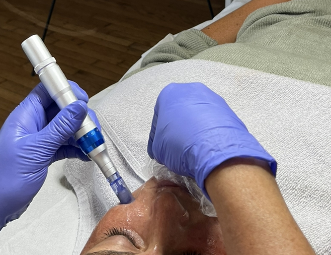 MicroNeedle Face, Neck, & Décolleté