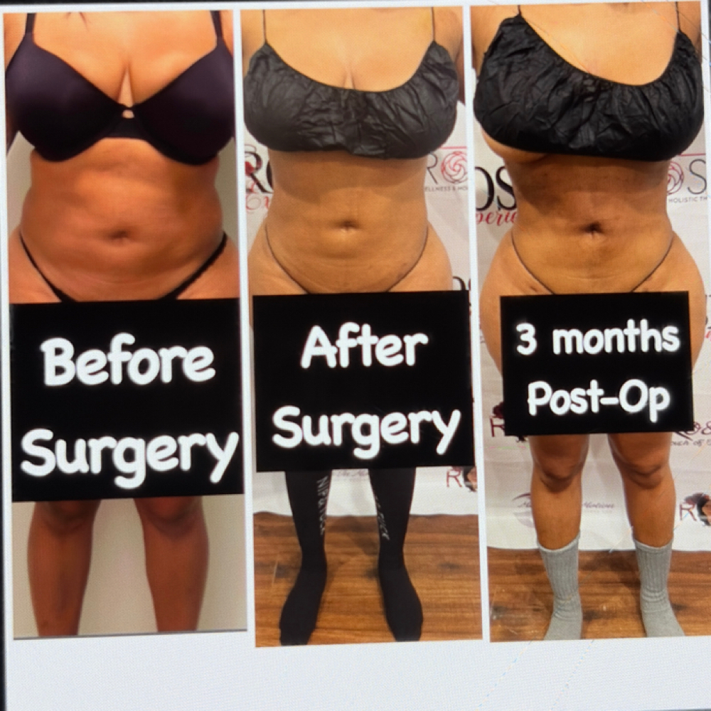 Post-Op Lymphatic Drainage at E Rose Health Wellness Holistic Therapy in Southfield, MI