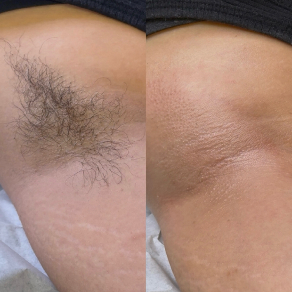 Underarms at Esthetics by Yari in Grayslake, IL