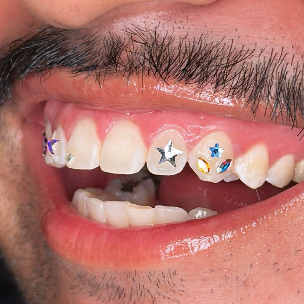 2 to 4 Tooth Freestyle at Solecita Gems in Los Angeles, CA