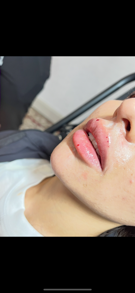 Full Lip Filler Syringe at Bratz Bliss by Yesenia in Fort Worth, TX