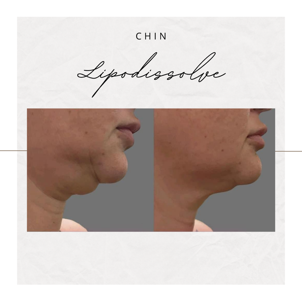 Chin Lipo