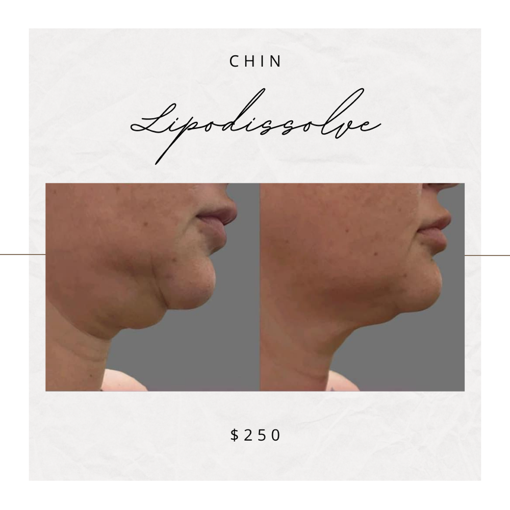 Chin Lipo