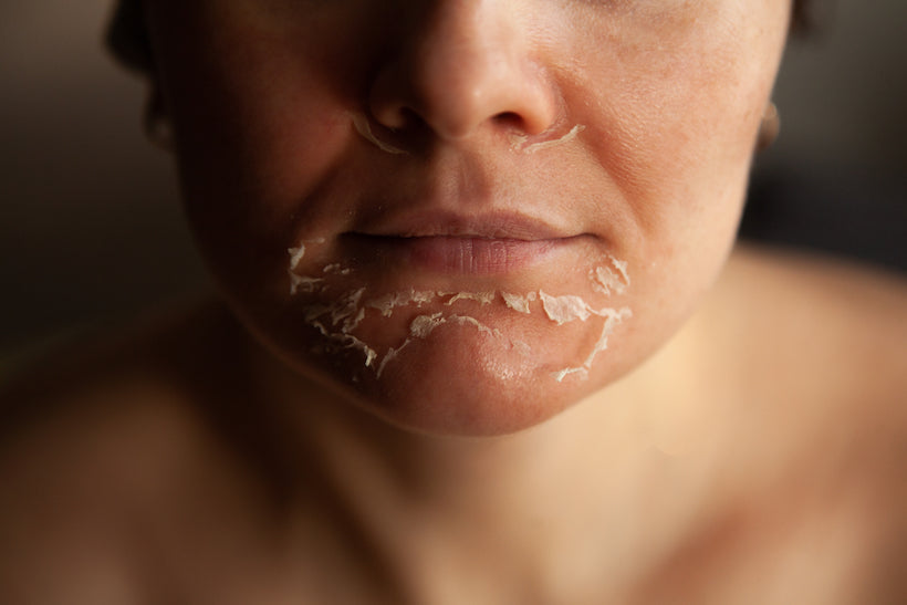 Chemical Peel