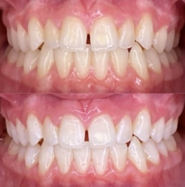 Signature Smile - Teeth Whitening