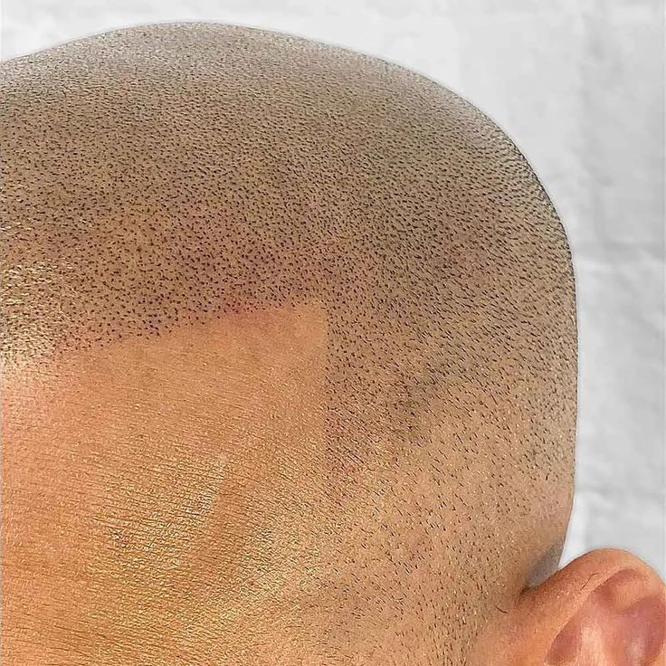 Scalp Micropigmentation (session)
