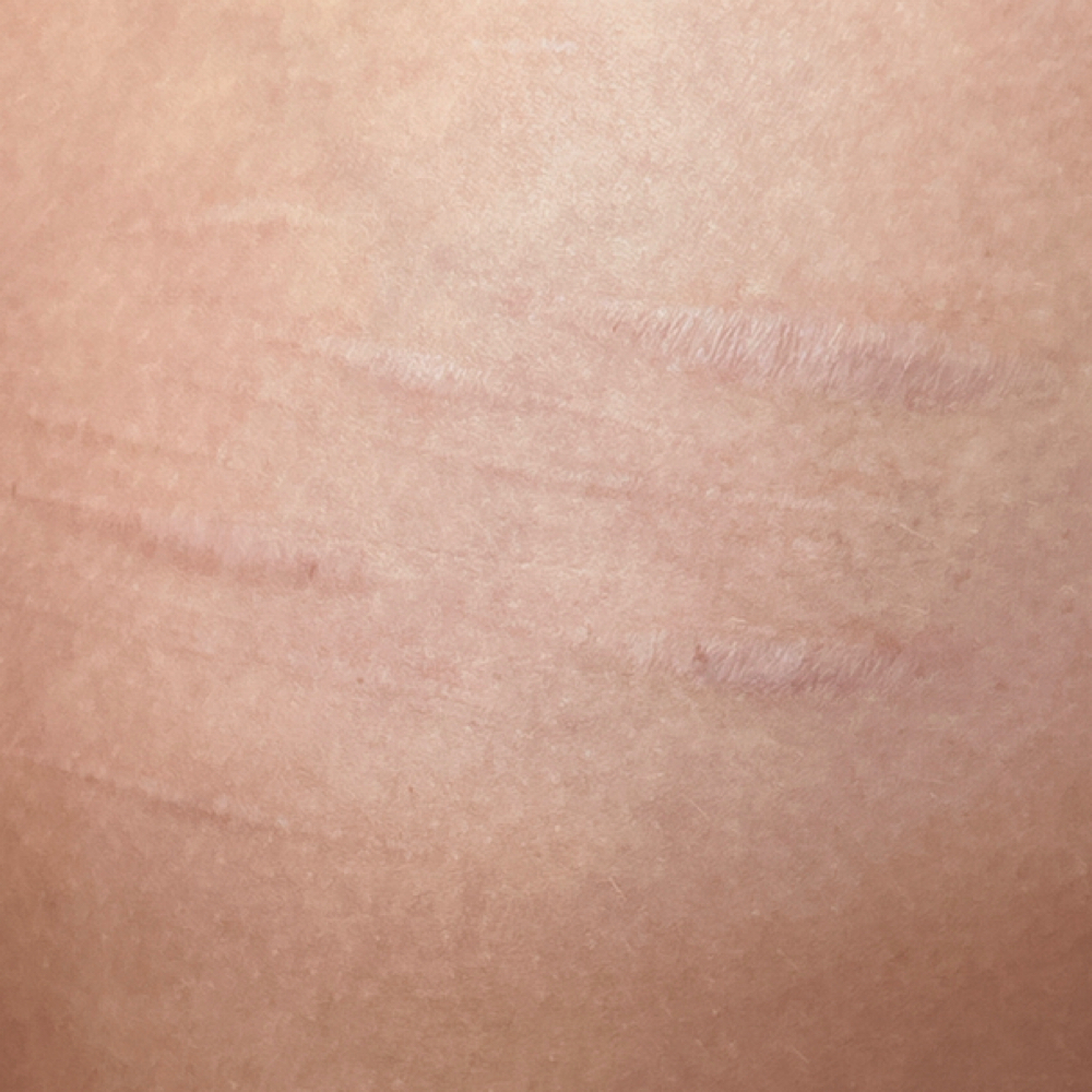 Inkless Scar Revision at Sharpe Brows in Quincy, IL
