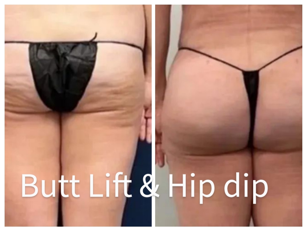 Butt Lift & Hip Dip