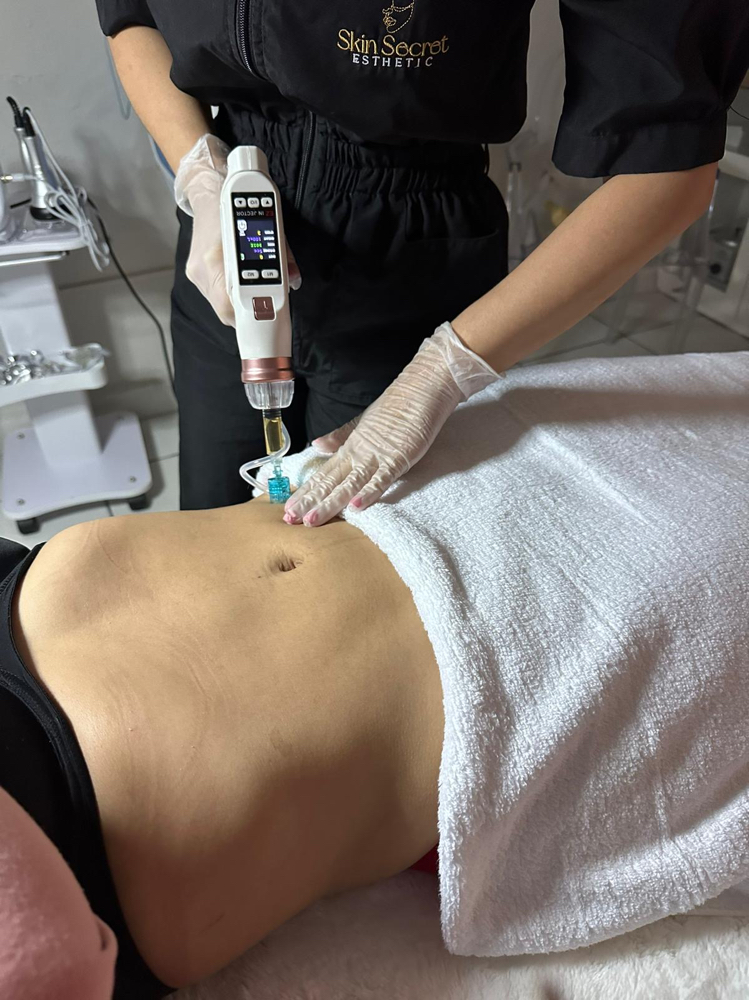 Mesoterapia