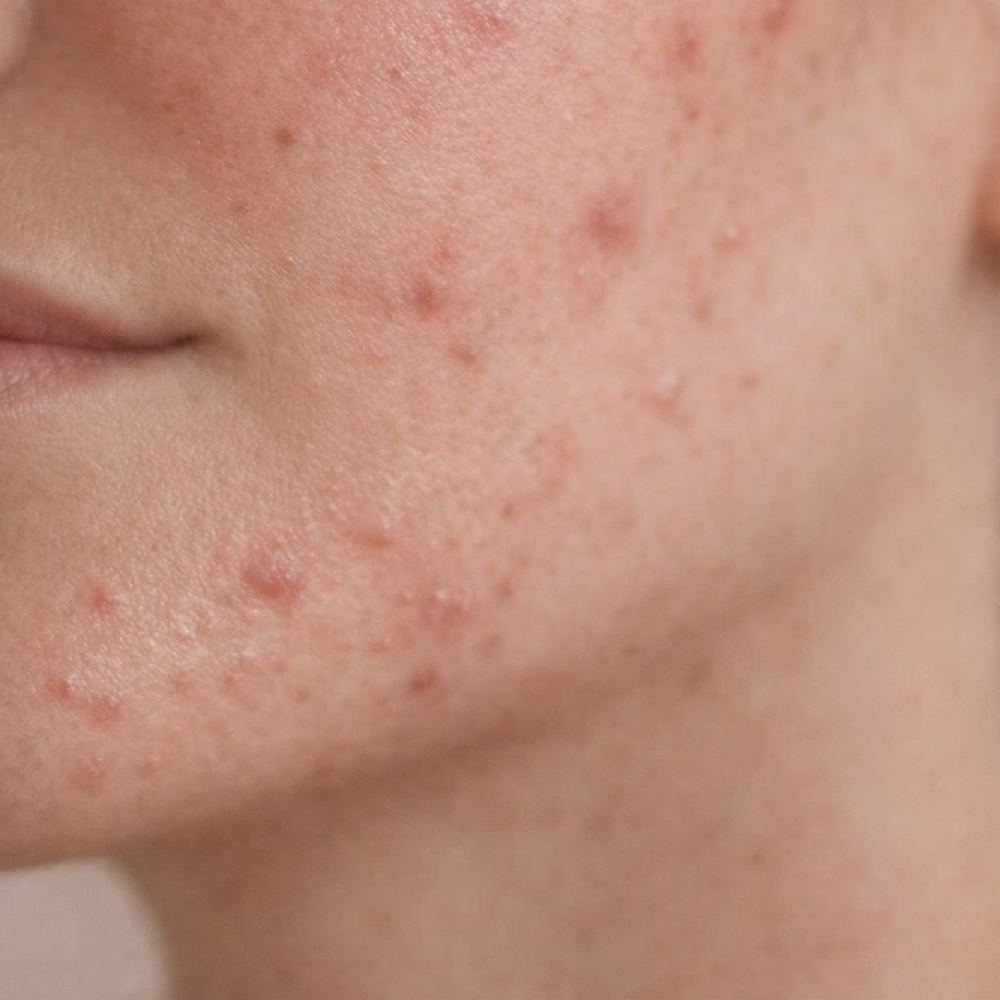 ACNE FACIAL at Fountain of Youth Spa in Yuma, AZ