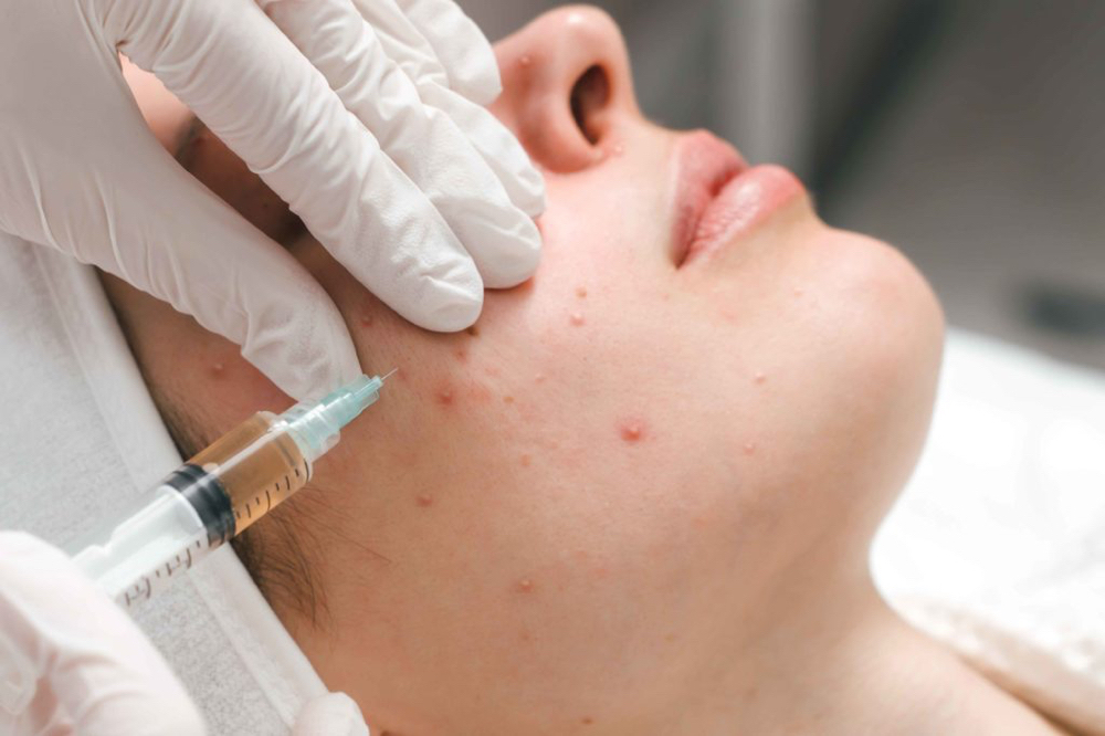 Acne Injection (Kenalog)