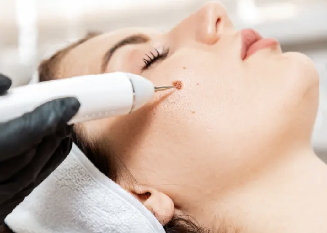 Skin Tags (1-2)