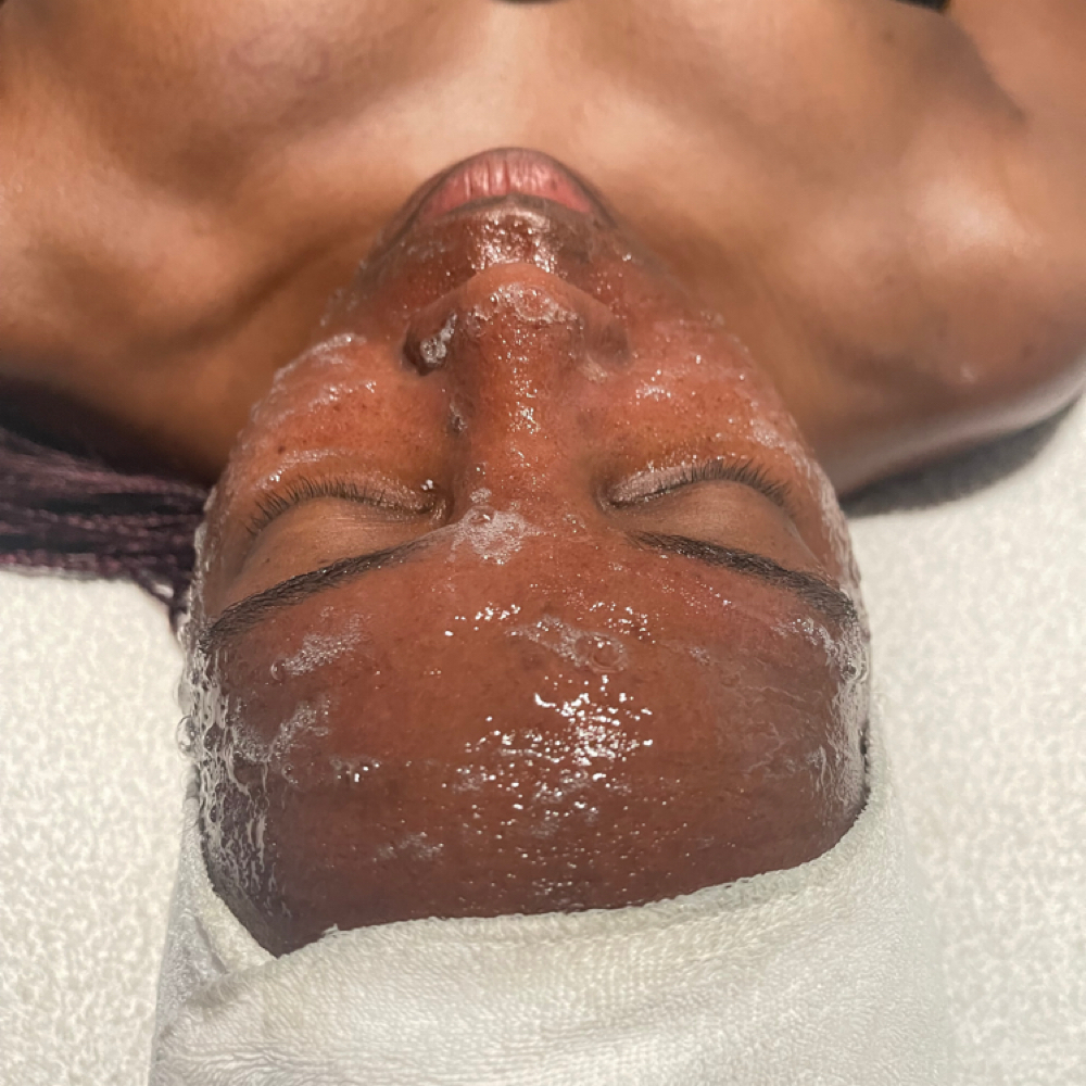 CO2 Carboxy Treatment at Millennium Day Spa in Inglewood, CA