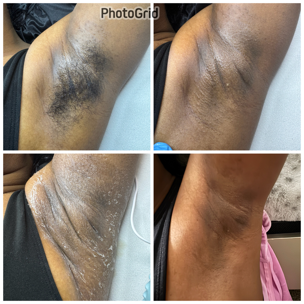 Intimate Bleaching Service