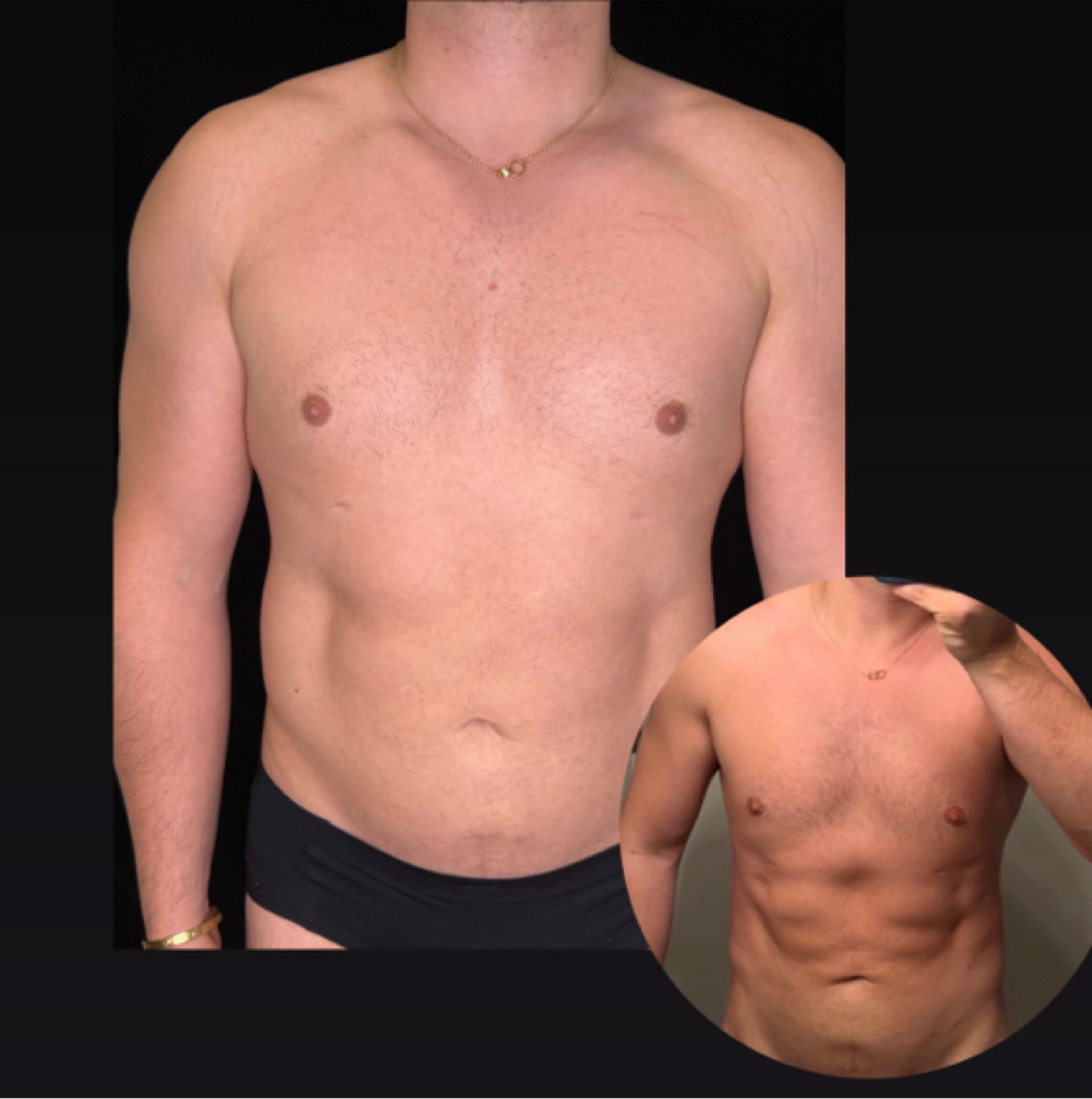 Trusculpt | body sculpt at Corrective treatments + professional skincare in Atlanta, GA