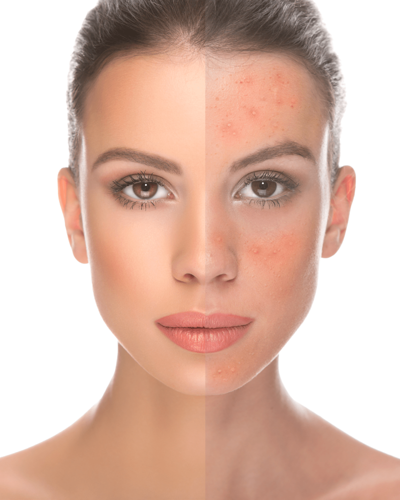 Laser Acne Treatment